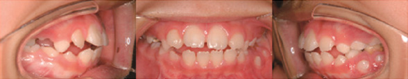개방교합 교정 전, 9세 남아