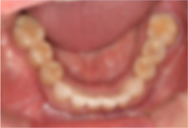 임플란트 치료 사례 3 치료 후