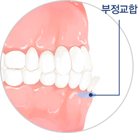 부정교합 모식도